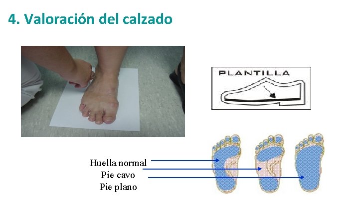  4. Valoración del calzado Huella normal Pie cavo Pie plano 