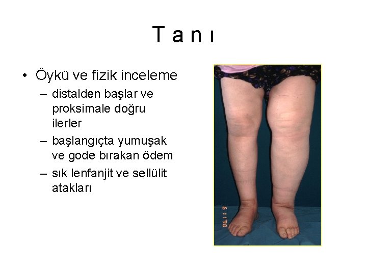 Tanı • Öykü ve fizik inceleme – distalden başlar ve proksimale doğru ilerler – Tanı • Öykü ve fizik inceleme – distalden başlar ve proksimale doğru ilerler –