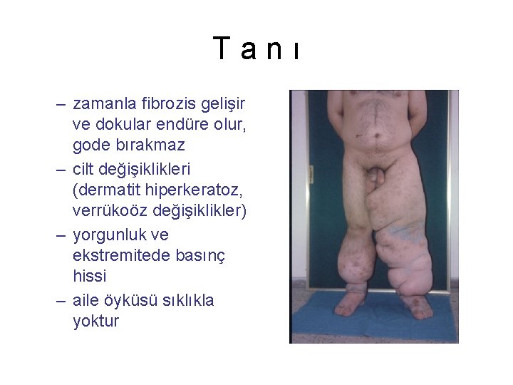 Tanı – zamanla fibrozis gelişir ve dokular endüre olur, gode bırakmaz – cilt değişiklikleri