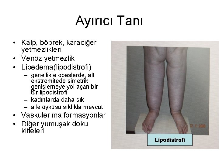 Ayırıcı Tanı • Kalp, böbrek, karaciğer yetmezlikleri • Venöz yetmezlik • Lipedema(lipodistrofi) – genellikle