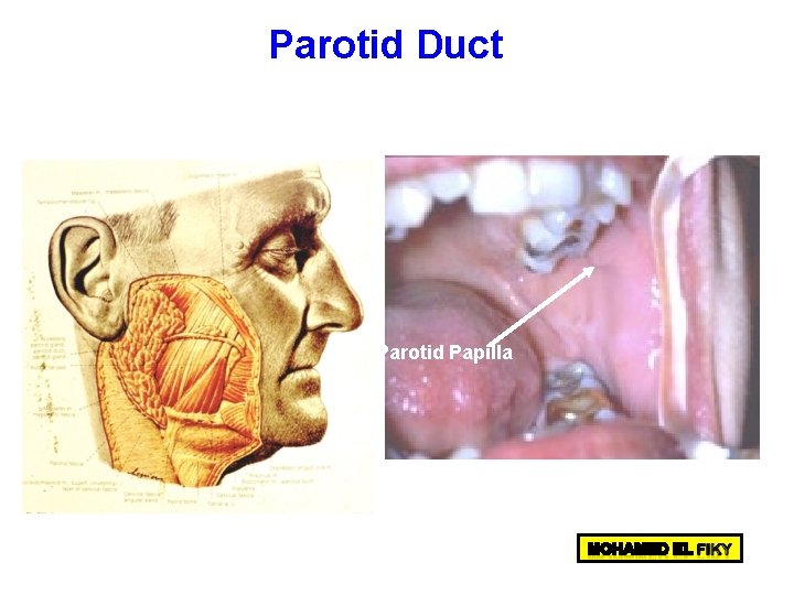 Parotid Duct Parotid Papilla Parotid Duct Parotid Papilla