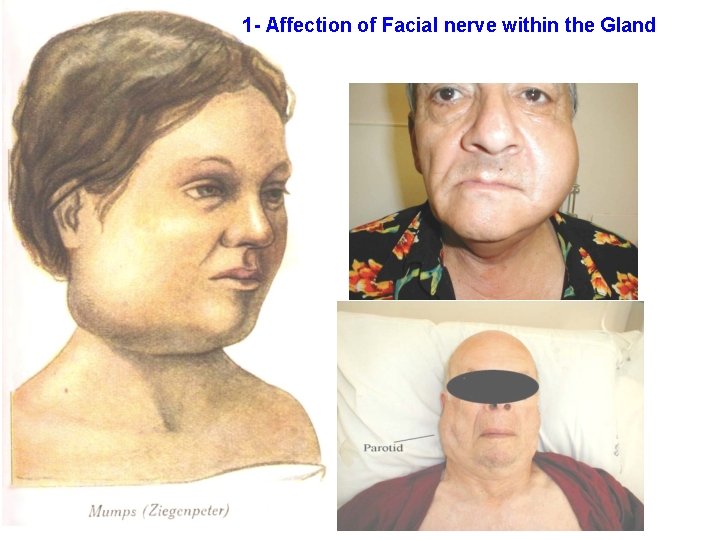 1 - Affection of Facial nerve within the Gland 