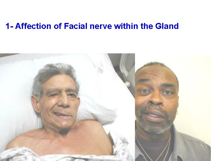 1 - Affection of Facial nerve within the Gland 