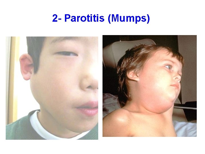 2 - Parotitis (Mumps) 