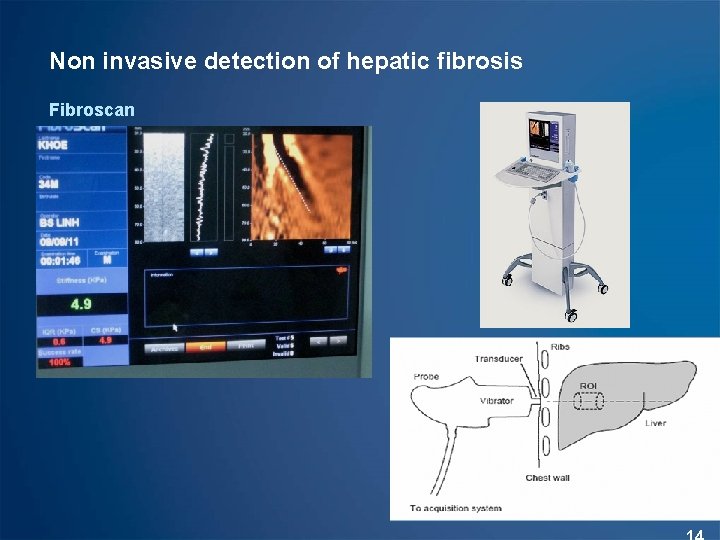 Non invasive detection of hepatic fibrosis Fibroscan 