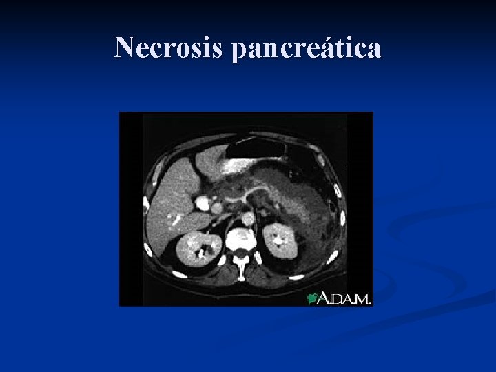 Necrosis pancreática 