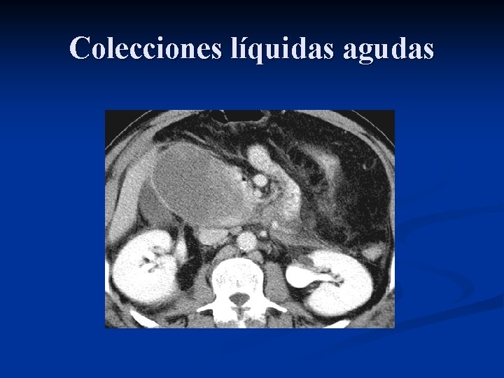 Colecciones líquidas agudas 