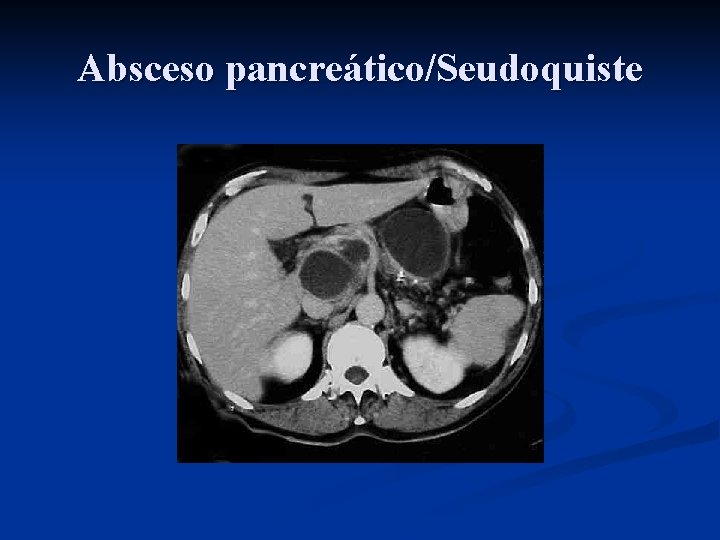 Absceso pancreático/Seudoquiste 