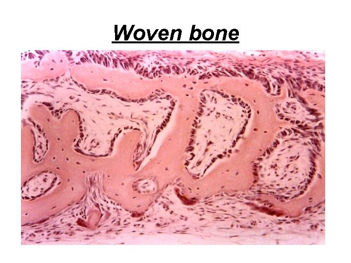 Woven bone 