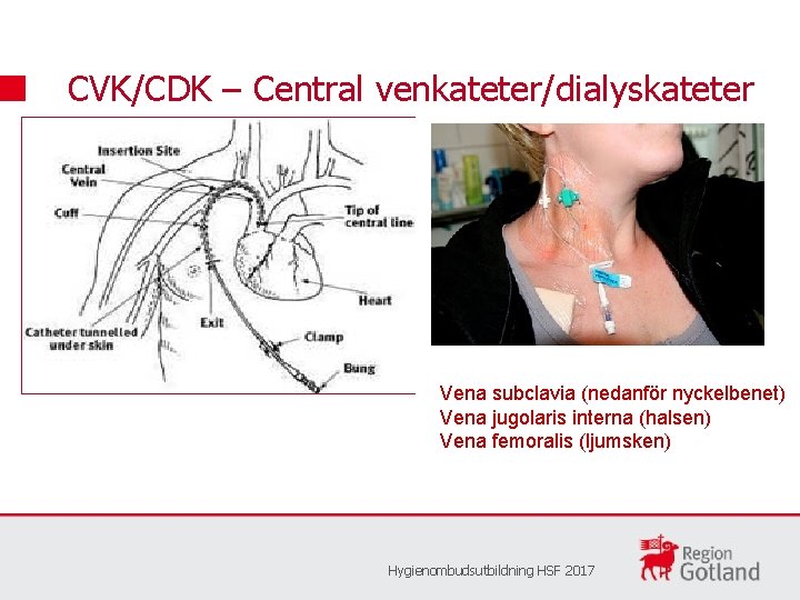 CVK/CDK – Central venkateter/dialyskateter Vena subclavia (nedanför nyckelbenet) Vena jugolaris interna (halsen) Vena femoralis