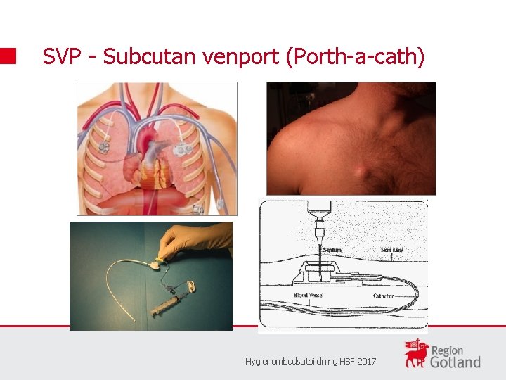 SVP - Subcutan venport (Porth-a-cath) Hygienombudsutbildning HSF 2017 