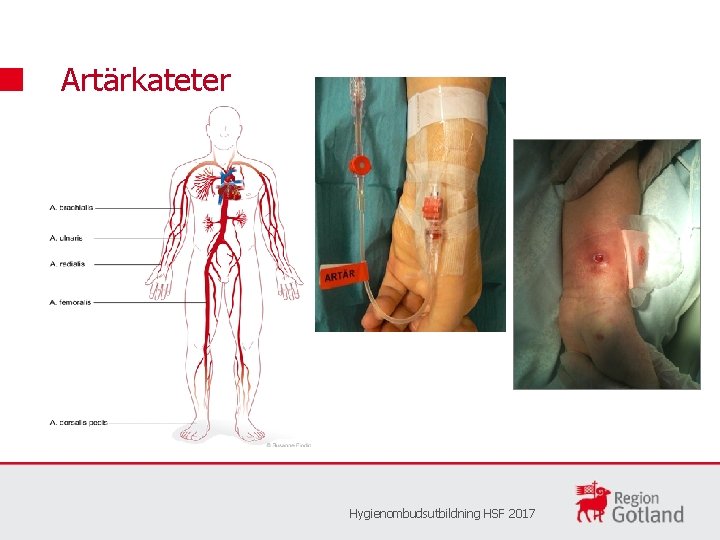 Artärkateter Hygienombudsutbildning HSF 2017 