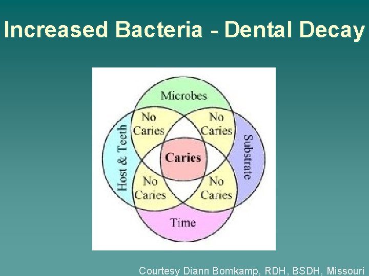 Increased Bacteria - Dental Decay Courtesy Diann Bomkamp, RDH, BSDH, Missouri 
