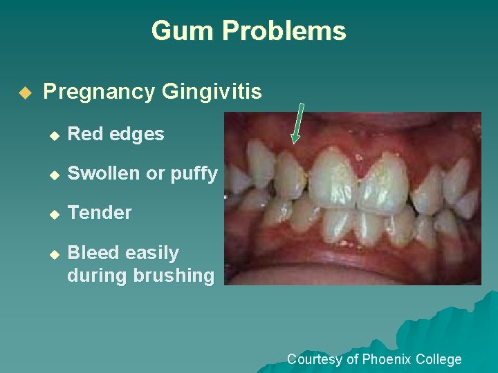 Gum Problems u Pregnancy Gingivitis u Red edges u Swollen or puffy u Tender