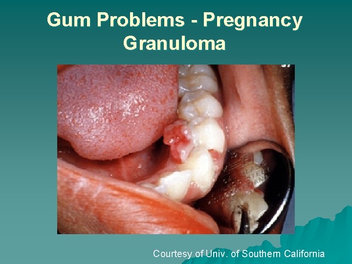 Gum Problems - Pregnancy Granuloma Courtesy of Univ. of Southern California 