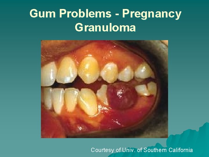 Gum Problems - Pregnancy Granuloma Courtesy of Univ. of Southern California 