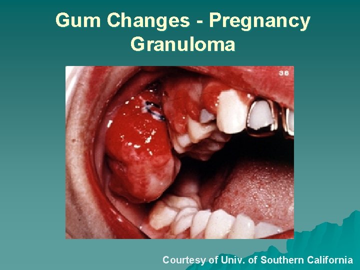 Gum Changes - Pregnancy Granuloma Courtesy of Univ. of Southern California 