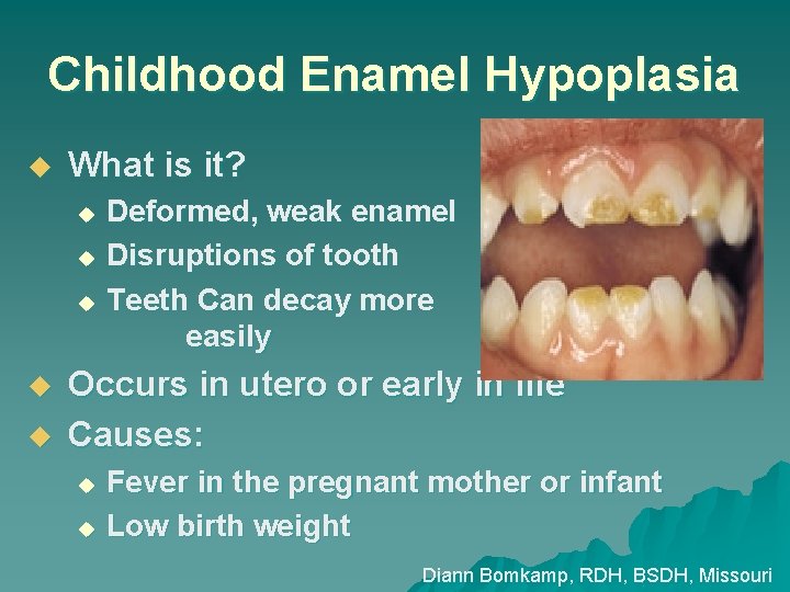 Childhood Enamel Hypoplasia u What is it? Deformed, weak enamel u Disruptions of tooth