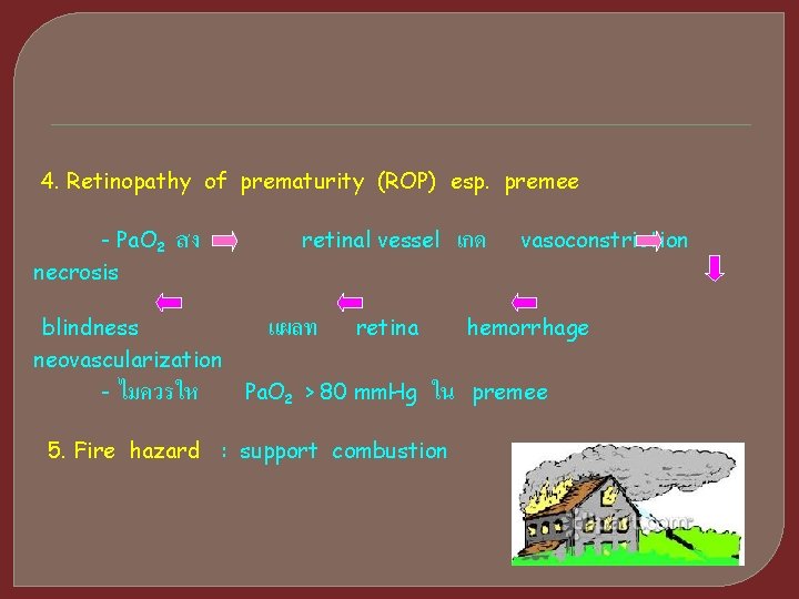 4. Retinopathy of prematurity (ROP) esp. premee - Pa. O 2 necrosis สง blindness