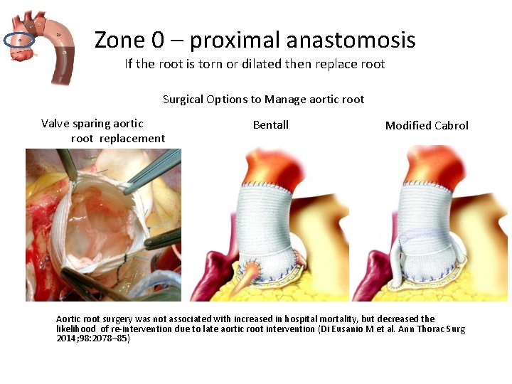 Zone 0 – proximal anastomosis If the root is torn or dilated then replace