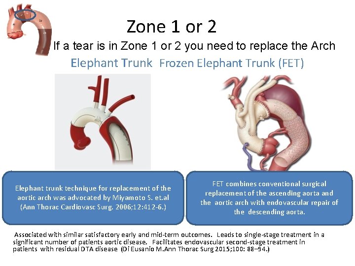 Zone 1 or 2 If If a tear is in Zone 1 or 2