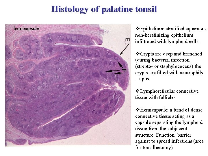 Histology of palatine tonsil hemicapsule v. Epithelium: stratified squamous non-keratinizing epithelium infiltrated with lymphoid