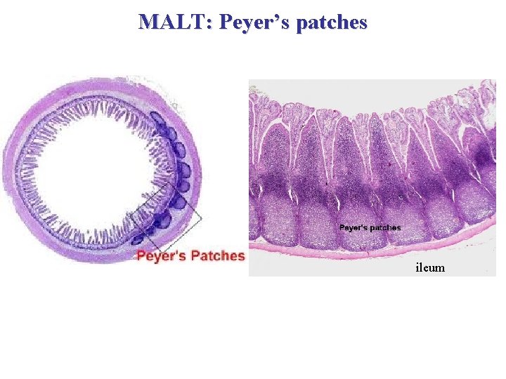 MALT: Peyer’s patches ileum 