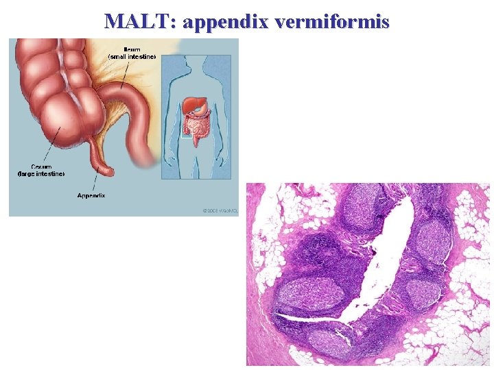 MALT: appendix vermiformis 
