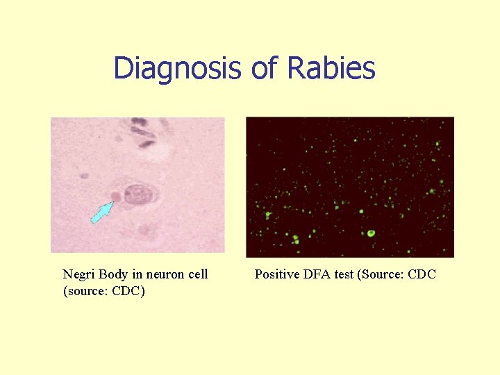 Diagnosis of Rabies Negri Body in neuron cell (source: CDC) Positive DFA test (Source: