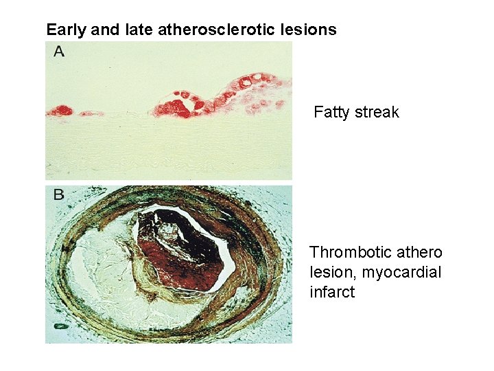 Early and late atherosclerotic lesions Fatty streak Thrombotic athero lesion, myocardial infarct Early and late atherosclerotic lesions Fatty streak Thrombotic athero lesion, myocardial infarct