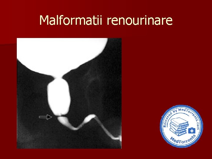 Malformatii renourinare 