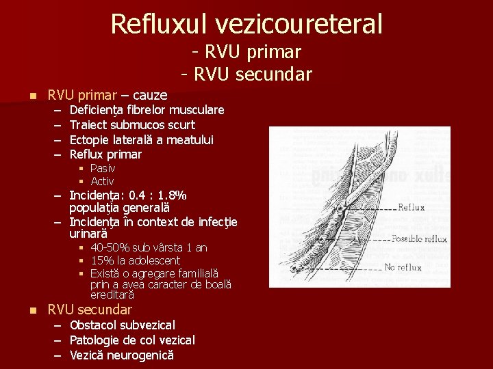 Refluxul vezicoureteral - RVU primar - RVU secundar n RVU primar – cauze –