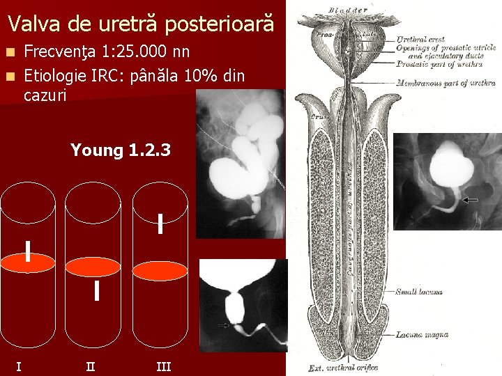 Valva de uretră posterioară Frecvenţa 1: 25. 000 nn n Etiologie IRC: pânăla 10%