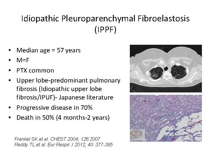 Idiopathic Pleuroparenchymal Fibroelastosis (IPPF) Median age = 57 years M=F PTX common Upper lobe-predominant