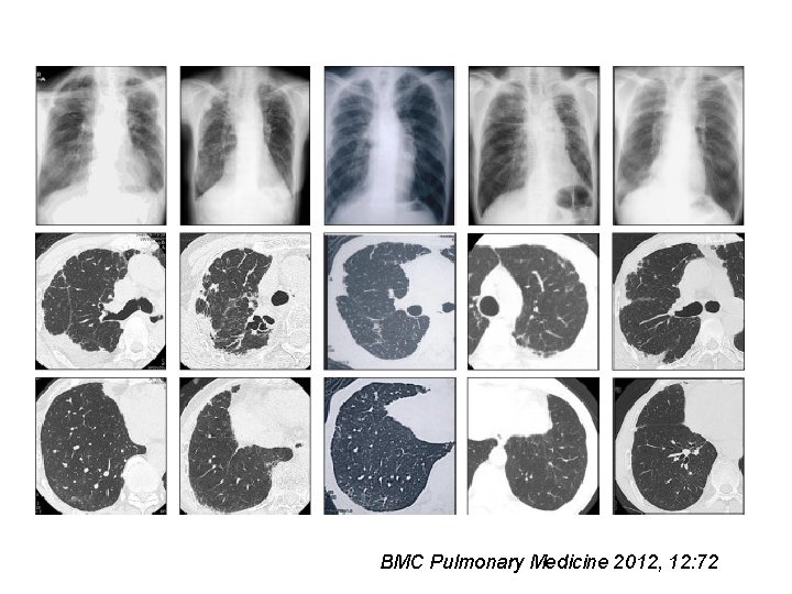 BMC Pulmonary Medicine 2012, 12: 72 