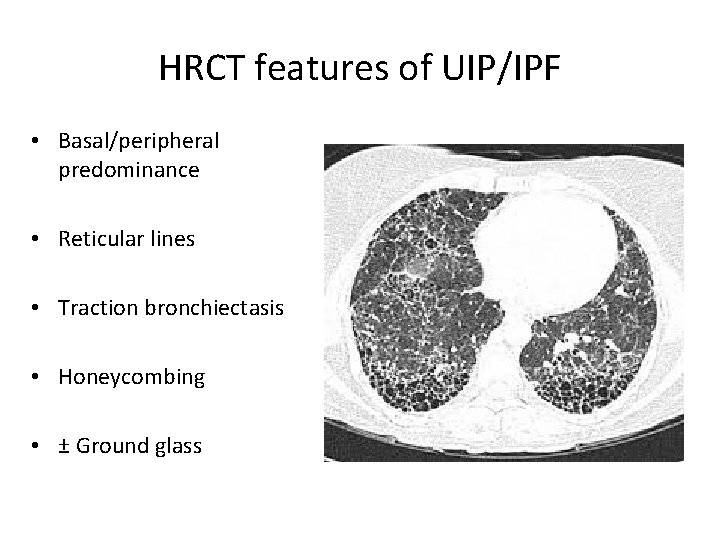 HRCT features of UIP/IPF • Basal/peripheral predominance • Reticular lines • Traction bronchiectasis •