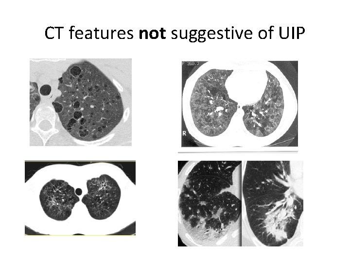 CT features not suggestive of UIP 