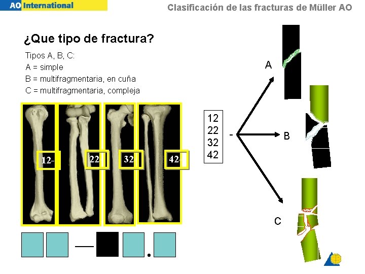 Clasificación de las fracturas de Müller AO ¿Que tipo de fractura? Tipos A, B,