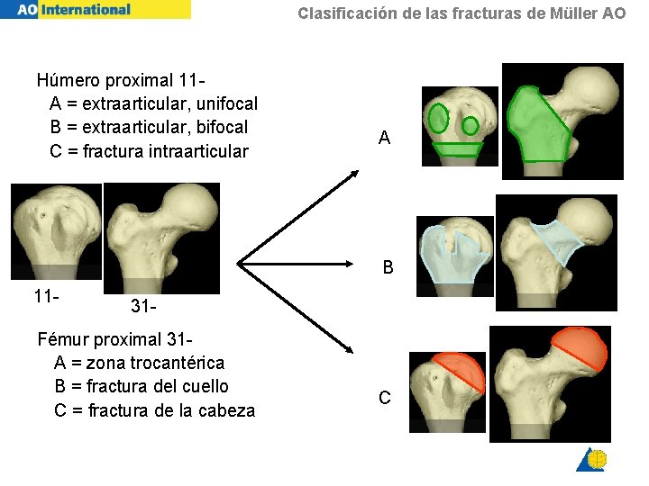 Clasificación de las fracturas de Müller AO Húmero proximal 11 A = extraarticular, unifocal