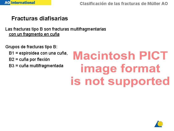 Clasificación de las fracturas de Müller AO Fracturas diafisarias Las fracturas tipo B son