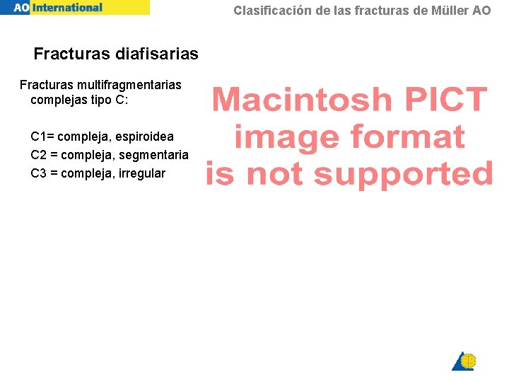 Clasificación de las fracturas de Müller AO Fracturas diafisarias Fracturas multifragmentarias complejas tipo C: