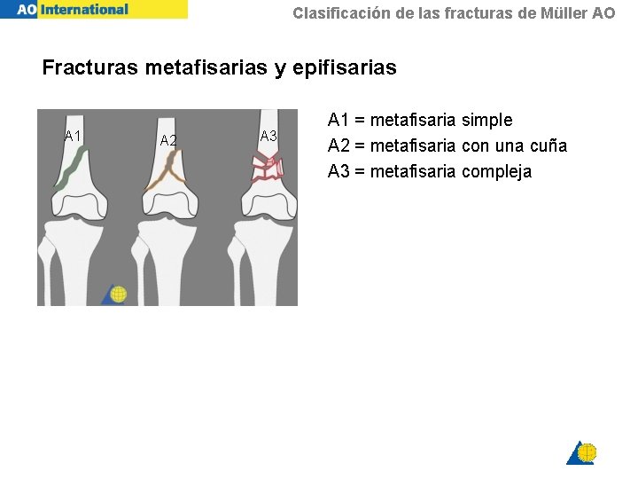 Clasificación de las fracturas de Müller AO Fracturas metafisarias y epifisarias A 1 A