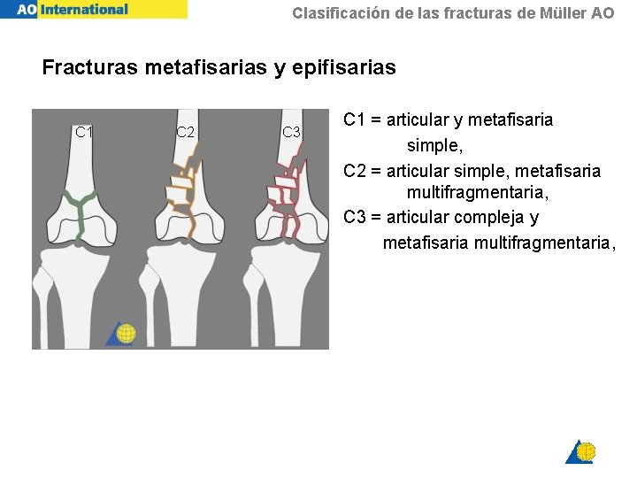 Clasificación de las fracturas de Müller AO Fracturas metafisarias y epifisarias C 1 C