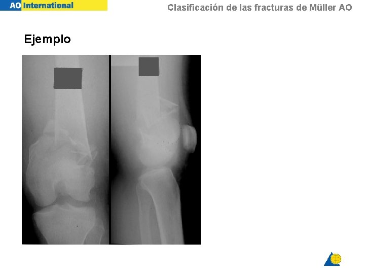 Clasificación de las fracturas de Müller AO Ejemplo 