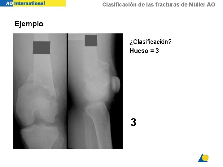 Clasificación de las fracturas de Müller AO Ejemplo ¿Clasificación? Hueso = 3 3 