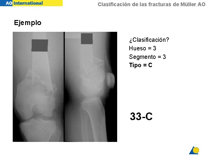 Clasificación de las fracturas de Müller AO Ejemplo ¿Clasificación? Hueso = 3 Segmento =