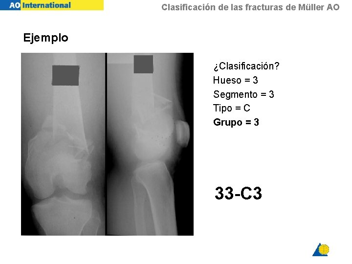 Clasificación de las fracturas de Müller AO Ejemplo ¿Clasificación? Hueso = 3 Segmento =