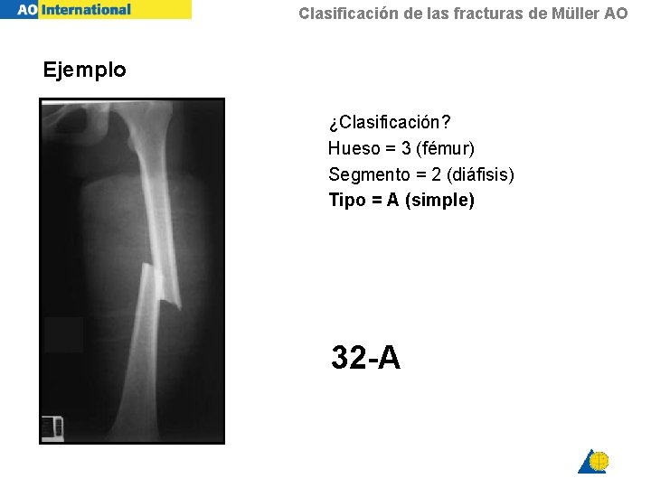 Clasificación de las fracturas de Müller AO Ejemplo ¿Clasificación? Hueso = 3 (fémur) Segmento