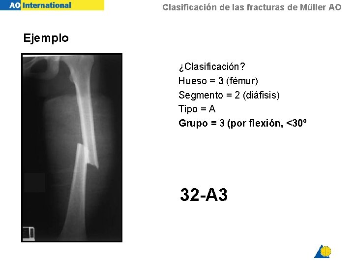 Clasificación de las fracturas de Müller AO Ejemplo ¿Clasificación? Hueso = 3 (fémur) Segmento