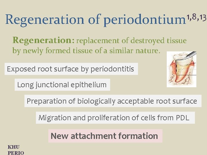 Regeneration of periodontium 1, 8, 13 Regeneration: replacement of destroyed tissue by newly formed